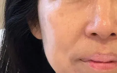 施術結果１の術後