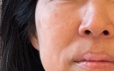 施術結果１の術前