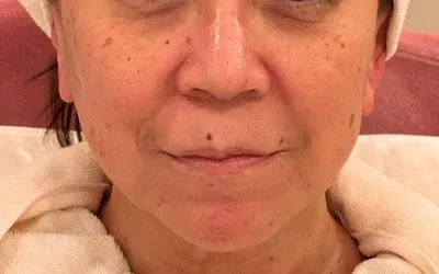 施術結果３の術前