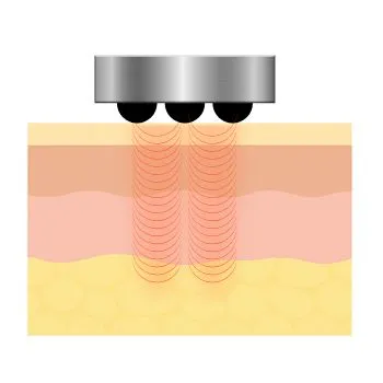 従来のマルチポーラーRF図解